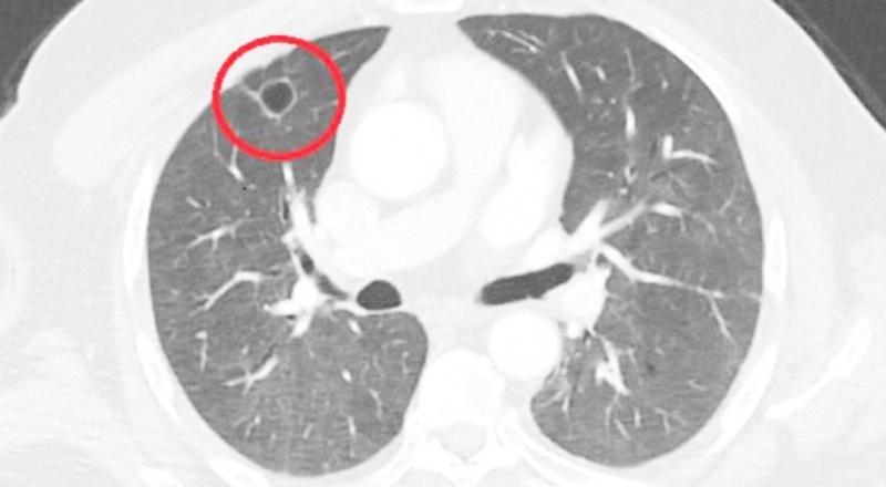 Covid-19, akciğer kanserini taklit etti